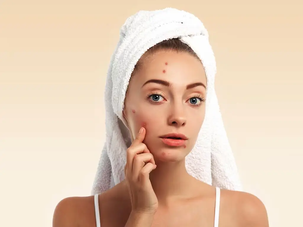 Deal your Acne Breakouts with Spectra Carbon Peel